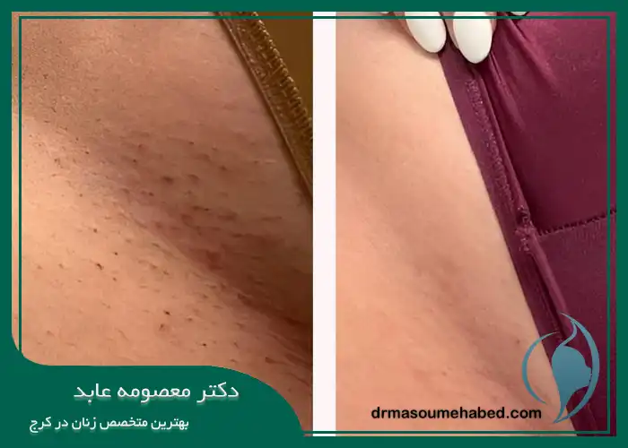 سفید کردن واژن در کرج