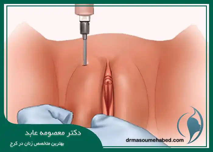 تزریق چربی به واژن