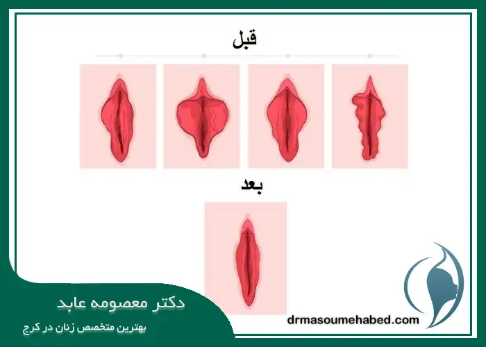 عمل لابیاپلاستی در کرج چقدر طول می ‌کشد؟