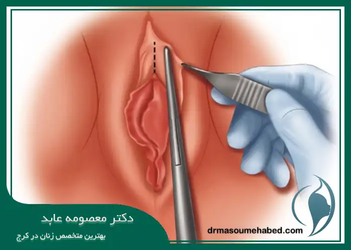 لابیاپلاستی در کرج 
