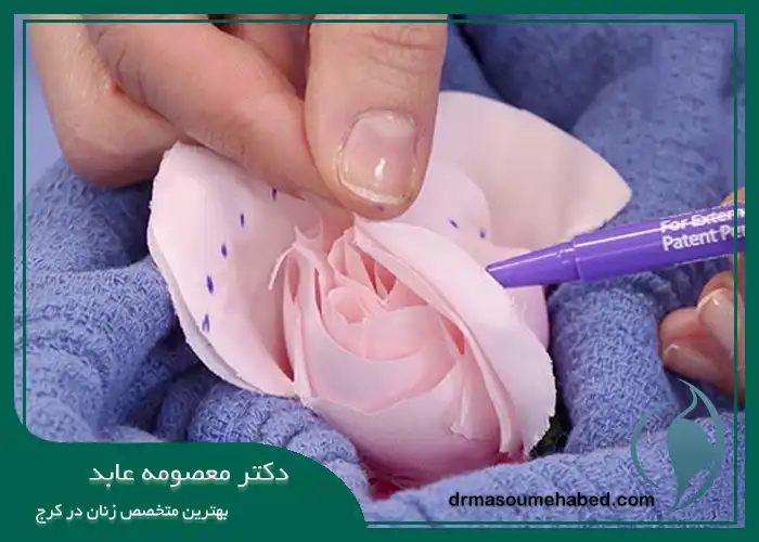 جراحی بازسازی (ترمیمی) لابیا در کرج