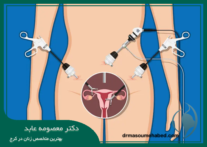 برداشتن رحم در کرج