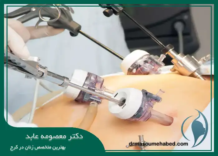 هیسترکتومی لاپاراسکوپی در کرج 