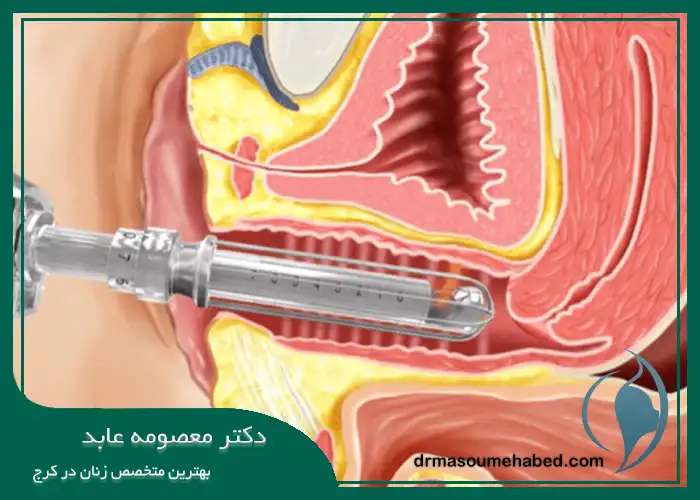 آیا RF واژینال در کرج همراه با درد است؟