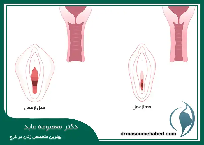 واژینوپلاستی در کرج