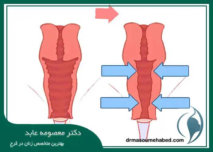 کاندید مناسب و نامناسب برای جراحی تنگ کردن واژن