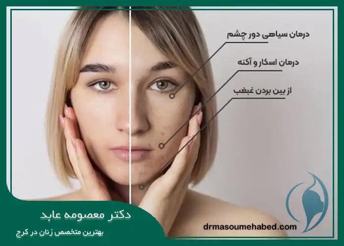 کربوکسی تراپی