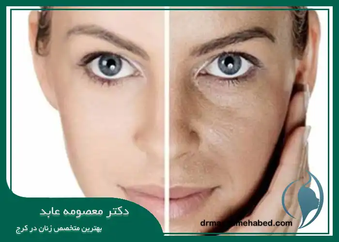 سوالات رایج درباره کربوکسی تراپی