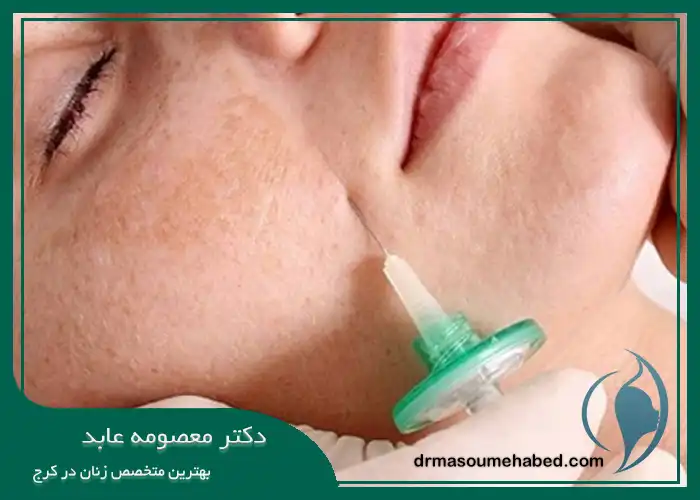 کربوکسی تراپی در کرج