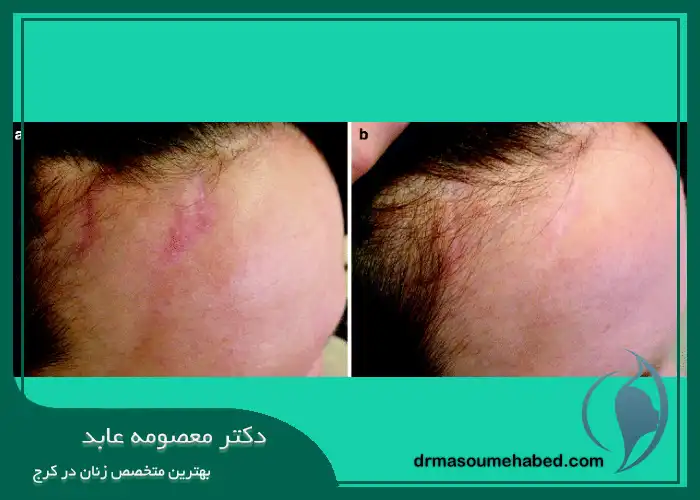 کربوکسی ‌تراپی جای بخیه