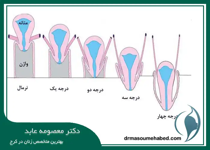 درجات و انواع افتادگی مثانه