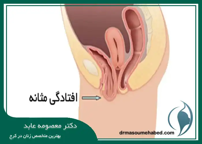 جراحی افتادگی مثانه در کرج