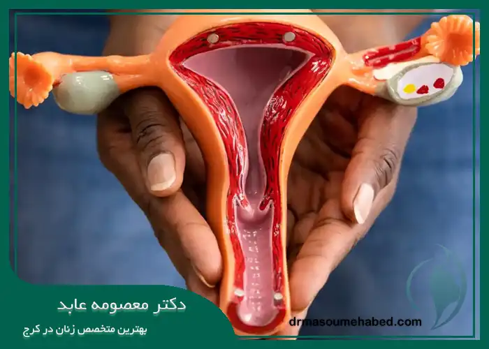 روش‌ های درمان افتادگی مثانه در کرج