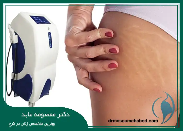 کربوکسی رفع اسکار ناشی از حاملگی در کرج