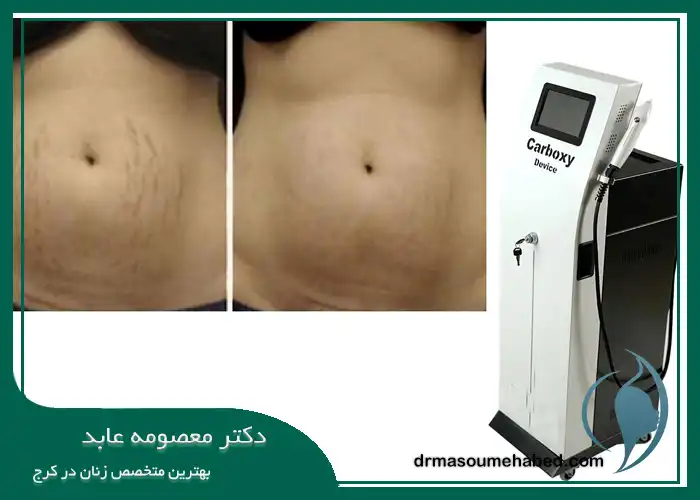 چند جلسه کربوکسی رفع اسکار ناشی از حاملگی در کرج لازم است؟