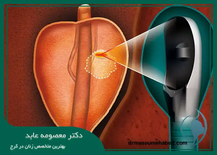 دی بی دی پلاسما در پزشکی زنان