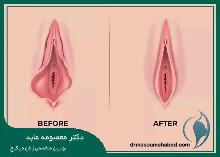 مزایای تزریق ژل به واژن