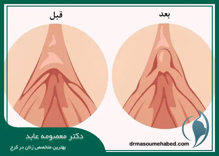 جراحی زیبایی کلیتوریس یا هودکتومی در کرج