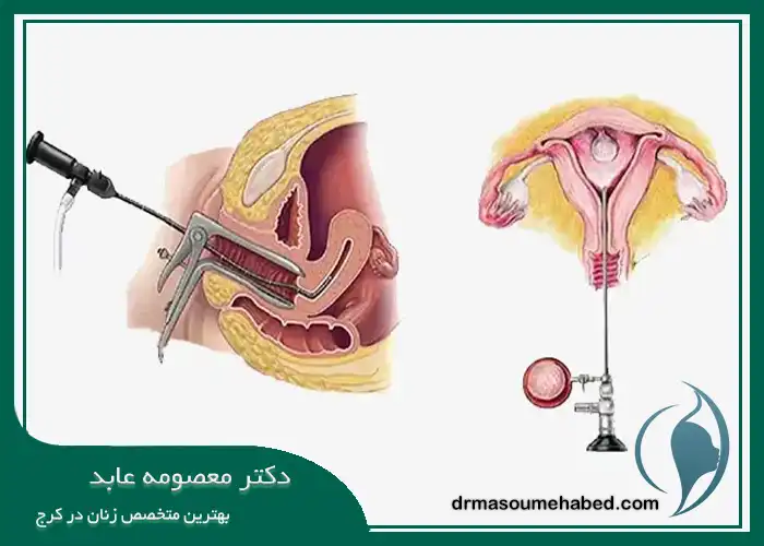 زمان مناسب برای انجام هیستروسکوپی رحم در کرج