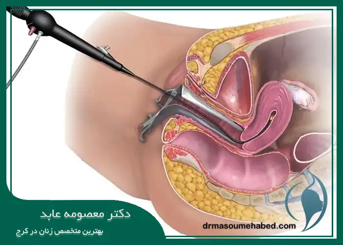 مزایای هیستروسکوپی رحم