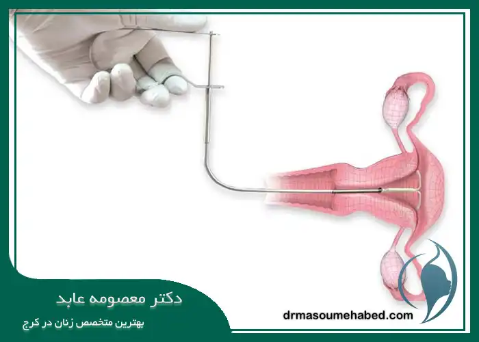 نحوه خارج کردن دستگاه IUD