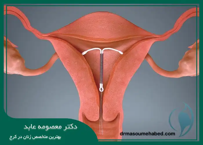 نحوه قرار دهی دستگاه IUD