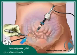 لاپاراسکوپی کیست تخمدان در کرج