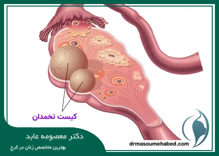 کیست ‌های تخمدان