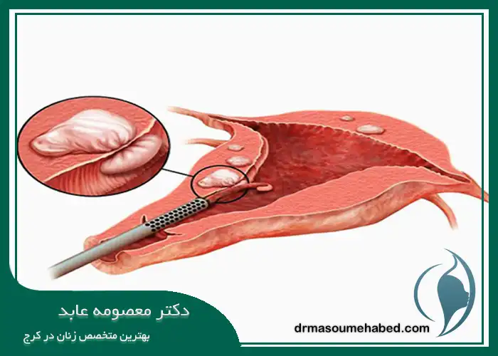 بهترین دکتر برای میومکتومی در کرج