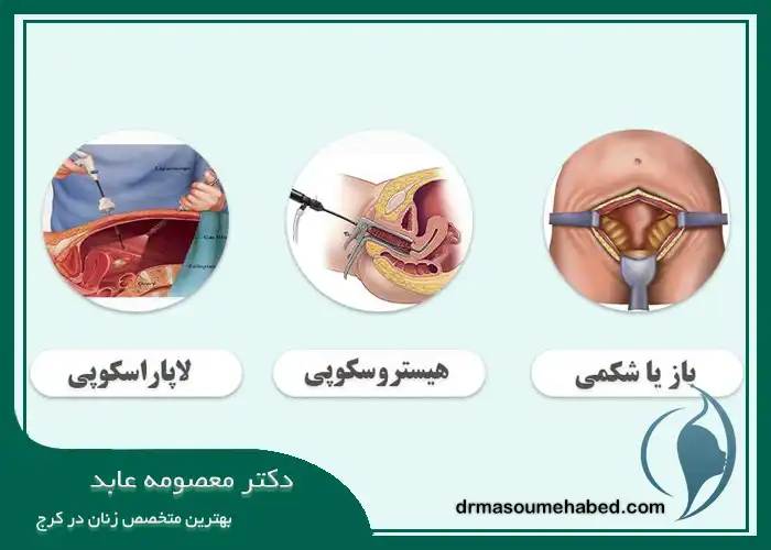 انواع روش‌ های میومکتومی