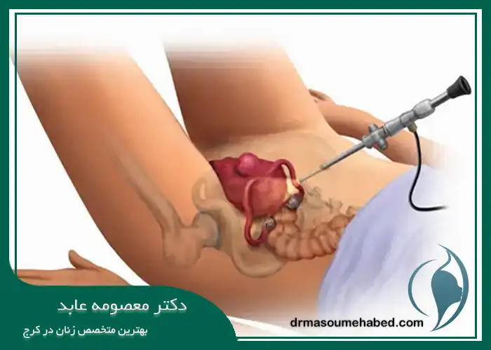 مراحل انجام میومکتومی در کرج