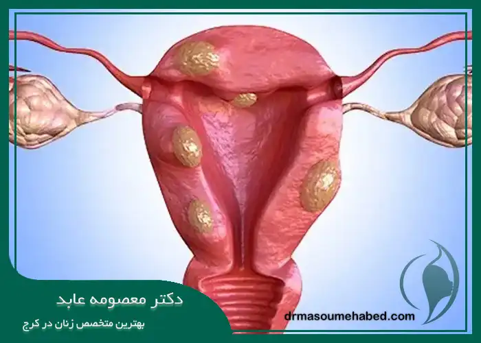 مزایا و معایب میومکتومی