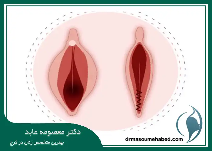 روش انجام جراحی پرینورافی در کرج