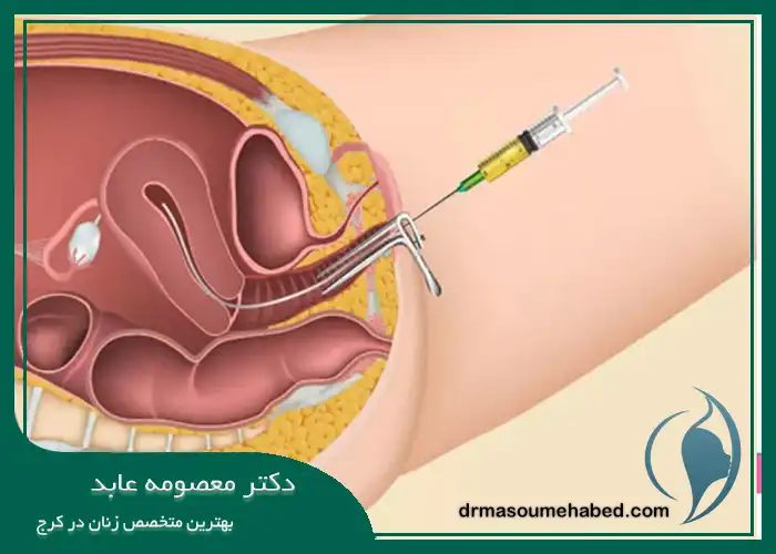 PRP واژن در کرج