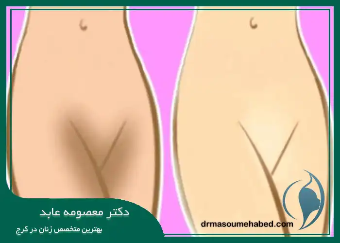 مزایا سفید کردن ناحیه تناسلی با روش پی آر پی واژن