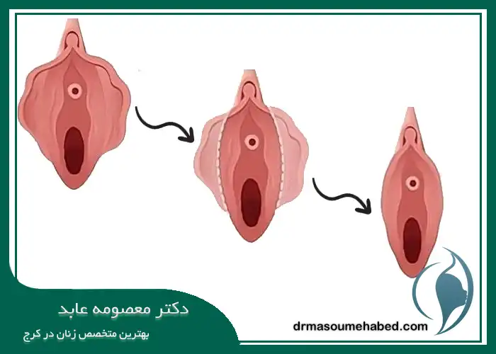 هزینه‌ لابیاپلاستی با لیزر