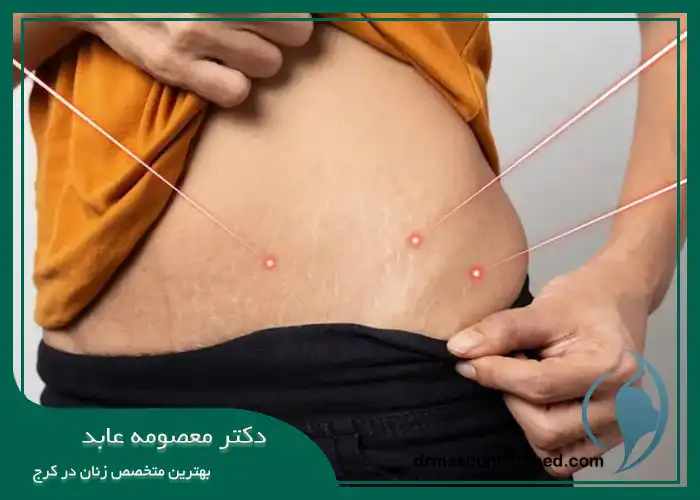 پلاسما جت ترک شکم