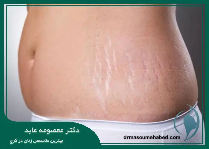 هزینه انجام روش پلاسما جت شکم