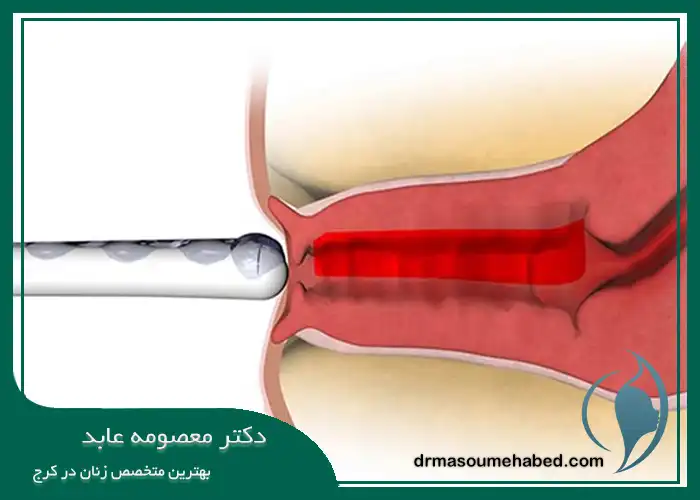پلاسما تراپی زخم دهانه رحم چگونه انجام می ‌شود؟