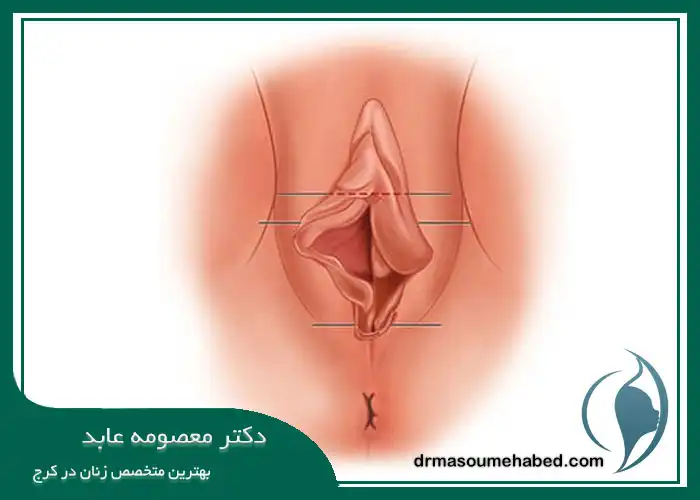 کاندیدای مناسب برای لابیاپلاستی