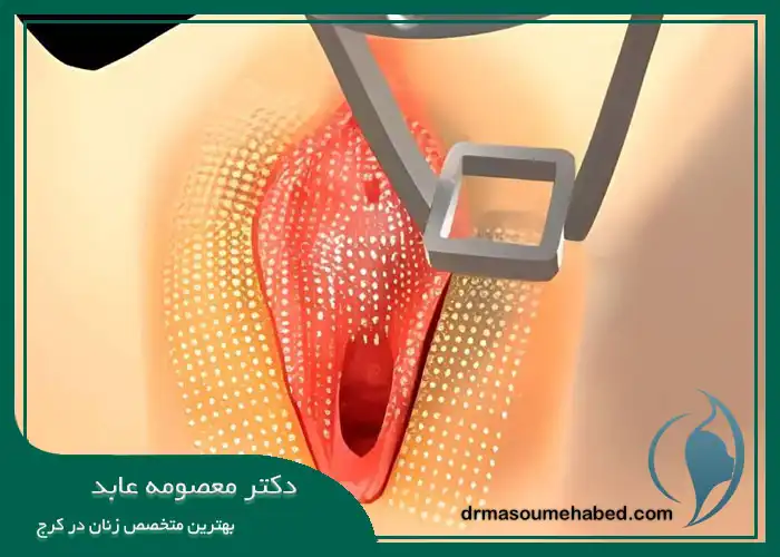 سفید کردن واژن با لیزر