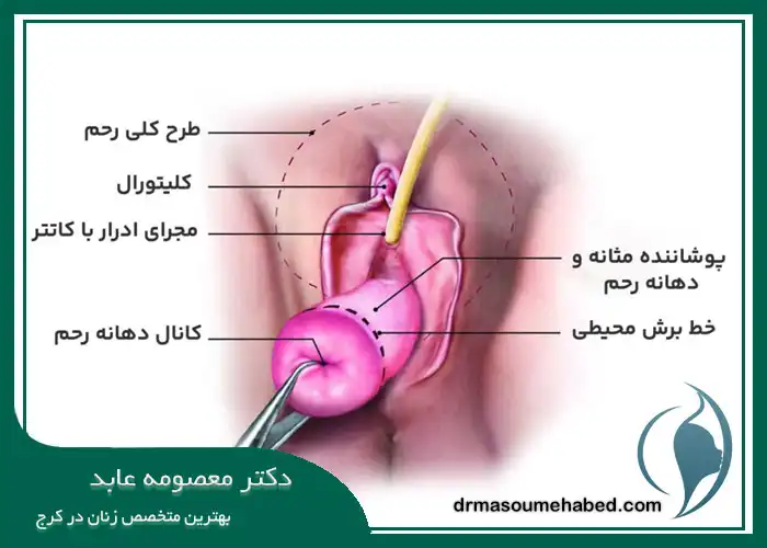 روش انجام هیسترکتومی واژینال در کرج