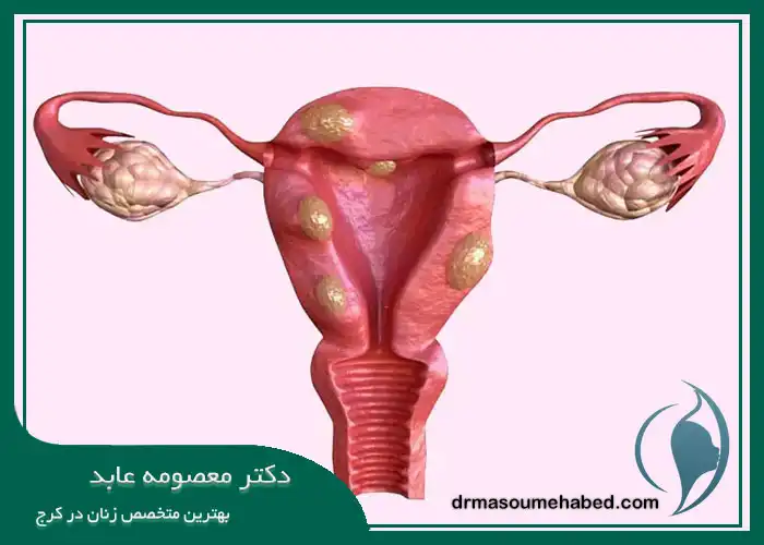 فیبروم رحمی (Uterine fibroids)