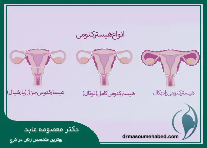 انواع هیسترکتومی