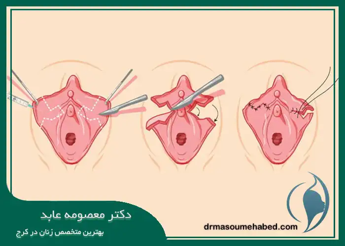 بهبود و اصلاح لابیای غیرطبیعی