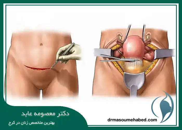 برداشتن رحم از طریق شکم
