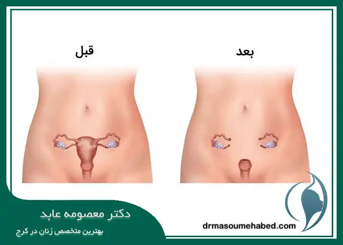 عوارض هیسترکتومی ابدومینال