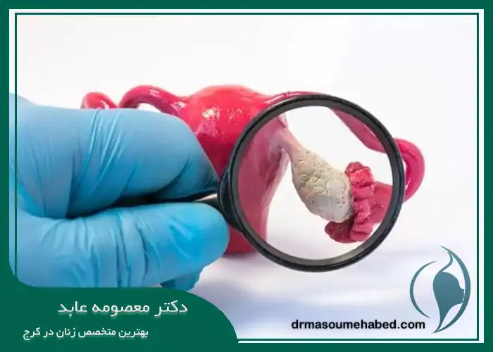 هیسترکتومی اوفورکتومی