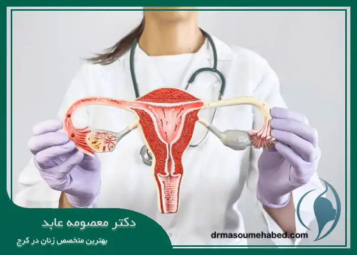 برداشتن رحم و تخمدان