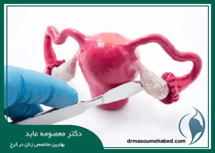 عمل هیسترکتومی اوفورکتومی